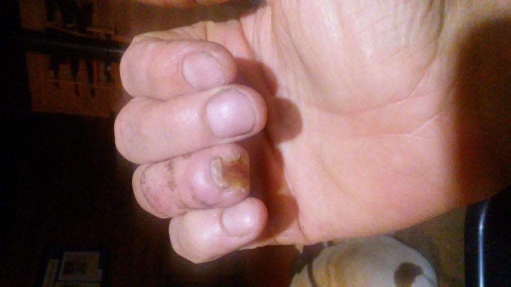 My finger 4 months into the healing process after being bitten off.